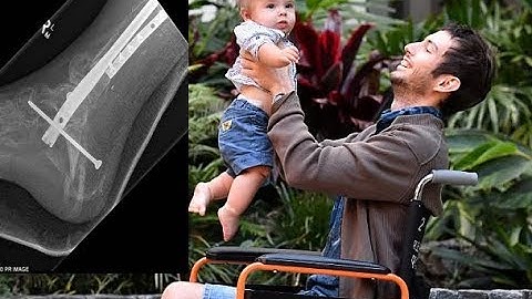 The man made on a 3D PRINTER: World-first surgery allows patient to walk again