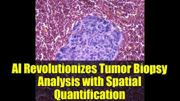 AI Revolutionizes Tumor Biopsy Analysis with Spatial Quantification