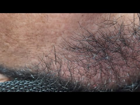 satisfying oddlysatisfying hairstyle thebarbersarms blackheadcaique #pimple blackheads