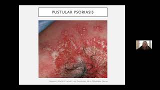 Blum Center Program: Updates on Psoriasis