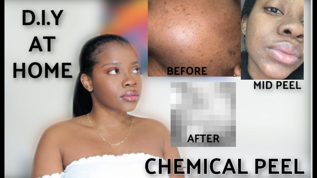 BEST AT HOME 20% GLYCOLIC ACID CHEMICAL PEEL FOR DARK SKIN W BEFORE AND AFTER PICS