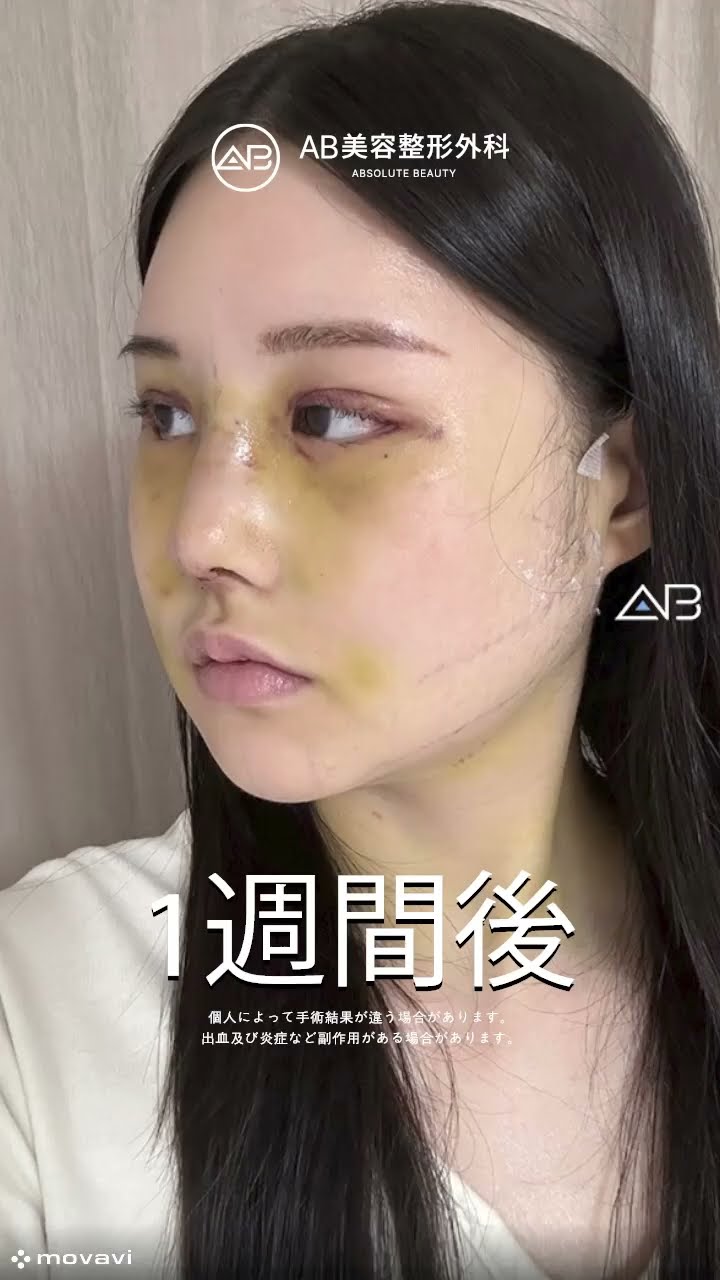 [韓國整形] 顔面輪郭 3点 + 目整形 + 鼻整形 #整形レビュー