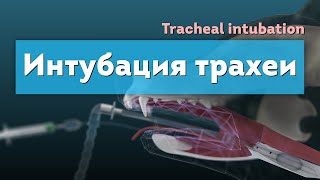 Интубация трахеи. Tracheal intubation 3D