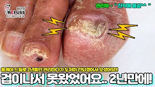 무좀으로 가득찬 무좀발톱.. 홈케어 드릴로 2년간 관리하다 도저히 안되겠어서 오셨어요!!! 겁이나셨다고ㅠㅠ #레푸스 #refuss #내성발톱 #무좀발톱 #발톱 #toenail