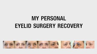 Blepharoplasty My personal eyelid surgery recovery Day 13 after treatment of lower eye bags
