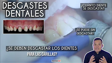 ¿Necesita una buena dentadura para las carillas?