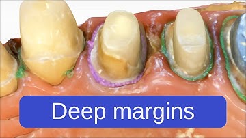 Managing extremely deep margins