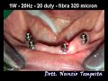 Laser Doctor Smile - Traitement Péri Implantite