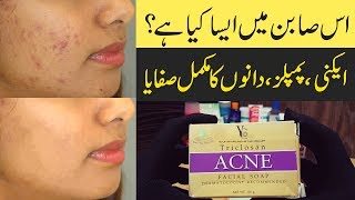 Acne & Pimples Simple Solutions a Treatment Urdu Hindi