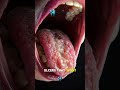 Do tongue scrapers actually work?