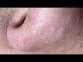 ШЄЩ ШёЩЉЩЃ Ш Щ ШЁШґШ Ш Щ Щ Ш Щ Ш Ш Щ Ші Ш Щ ШіЩ ШЇШ ШЎ How To Clean Your Skin From Black Head ШµШЇЩ Ш рџ ШЄЩ ШёЩЉЩЃ Ш Щ ШЁШґШ Ш Щ Щ Ш Щ Ш Ш Щ Ші Ш Щ ШіЩ ШЇШ ШЎ How To Clean Your Skin From Black Head ШµШЇЩ Ш рџ