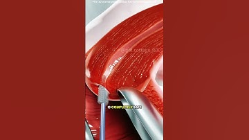 How intrauterine device (iud) is inserted? #drone #theflash #automobile #music #doctor #fluttercord