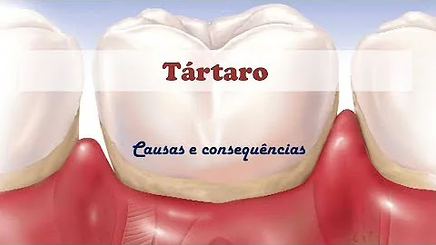 Qual é a causa do tártaro?