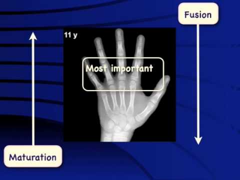 Bone Age Wrist Chart