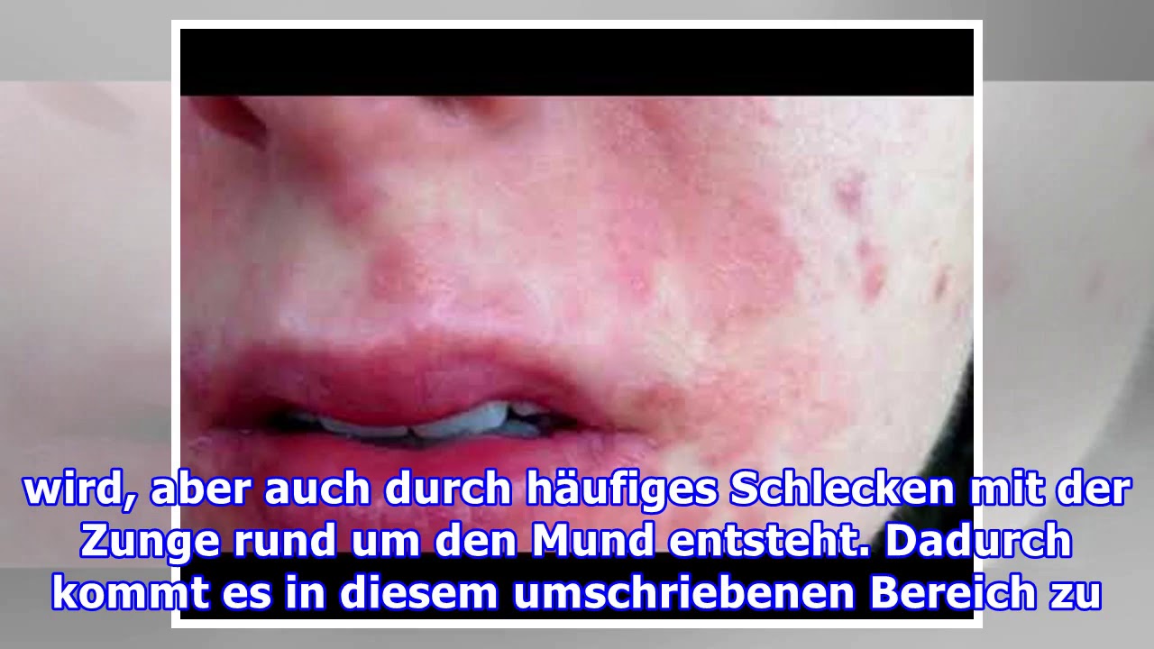 Ausschlag um den Mund Neurodermitis? YouTube Ausschlag um den Mund Neurodermitis? YouTube