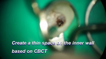 17985 challenging case for removal of a non visible broken file