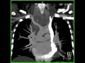 Cardiac: Persistent left superior vena cava emptying into coronary sinus (2 of 4)