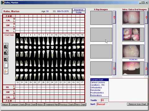 Dentrix Perio Charting