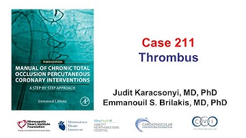 Case 211: Manual of CTO PCI - Thrombus