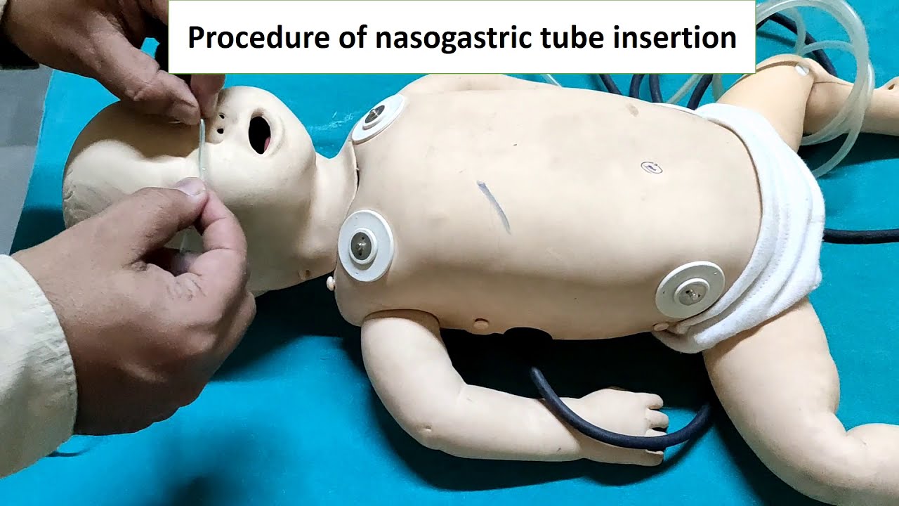 Nasogastric feeding Tube insertion | Ryles Tube | Pediatrics ...