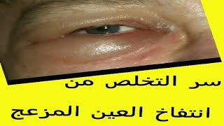 اسهل طريقة للتخلص من انتفاخ العين المزعج