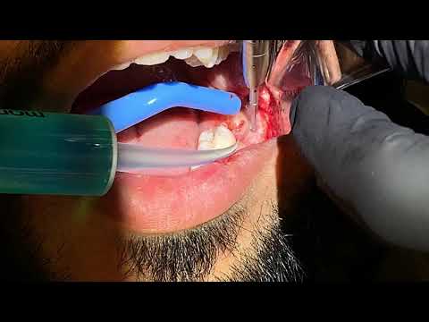 Video: How To Know When Teeth Are Being Cut