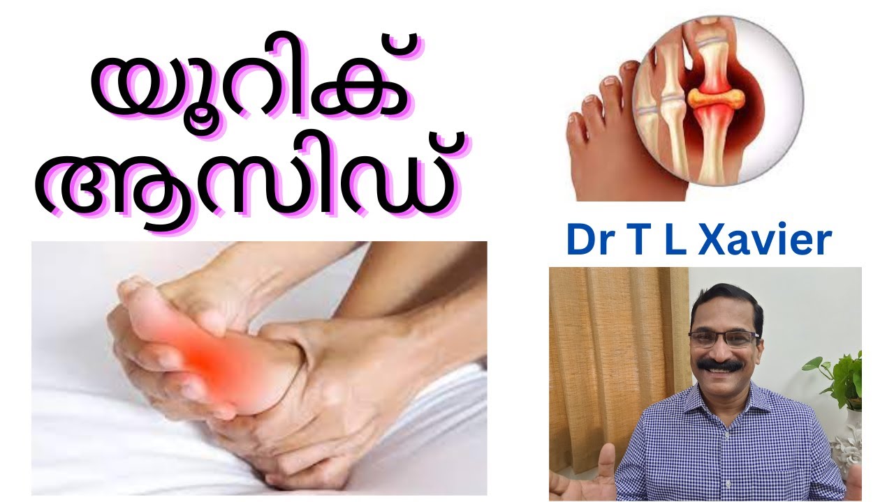 Managing Uric Acid Gout & Arthritis Naturally with Ayurveda - YouTube