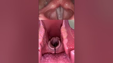 Live view of the vocal cords! #anatomy #medical #funfacts