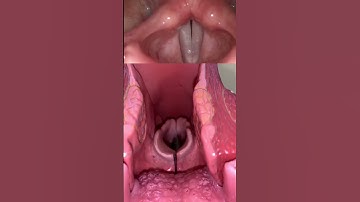 Thumbnail of Live view of the vocal cords! #anatomy #medical #funfacts