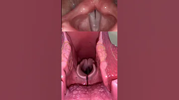 Live View Of The Vocal Cords Anatomy Medical Funfacts 