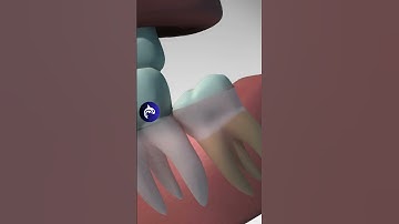 Wisdom Teeth: See Why and How They