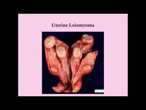 Uterine Leiomyoma (Fibroids) - CRASH! Medical Review Series