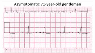 ECG in 60s - Case of ""Ventricular Bigeminy"