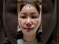 벌써 한달이 지났어요🎀 #안면거상술후기