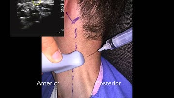 Cevical Plexus Nerve Block