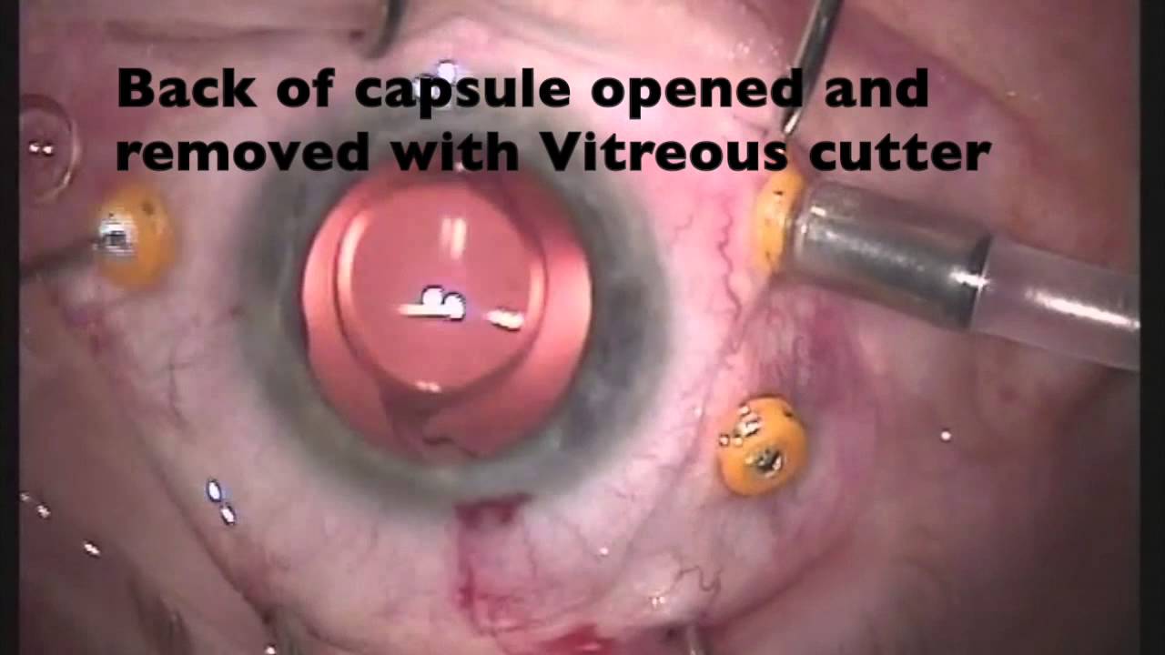 23G Phaco Vity Peel For Epiretinal Membrane 23G Phaco Vity Peel For Epiretinal Membrane