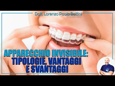 Video: Cosa Sono Gli Allineatori Invisibili