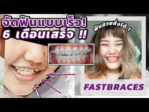 จัดฟันแบบเร็ว 6 เดือนเสร็จ !! ราคาเท่าไหร่ จัดที่ไหน ? มีคำตอบ !! l Bowkanyarat