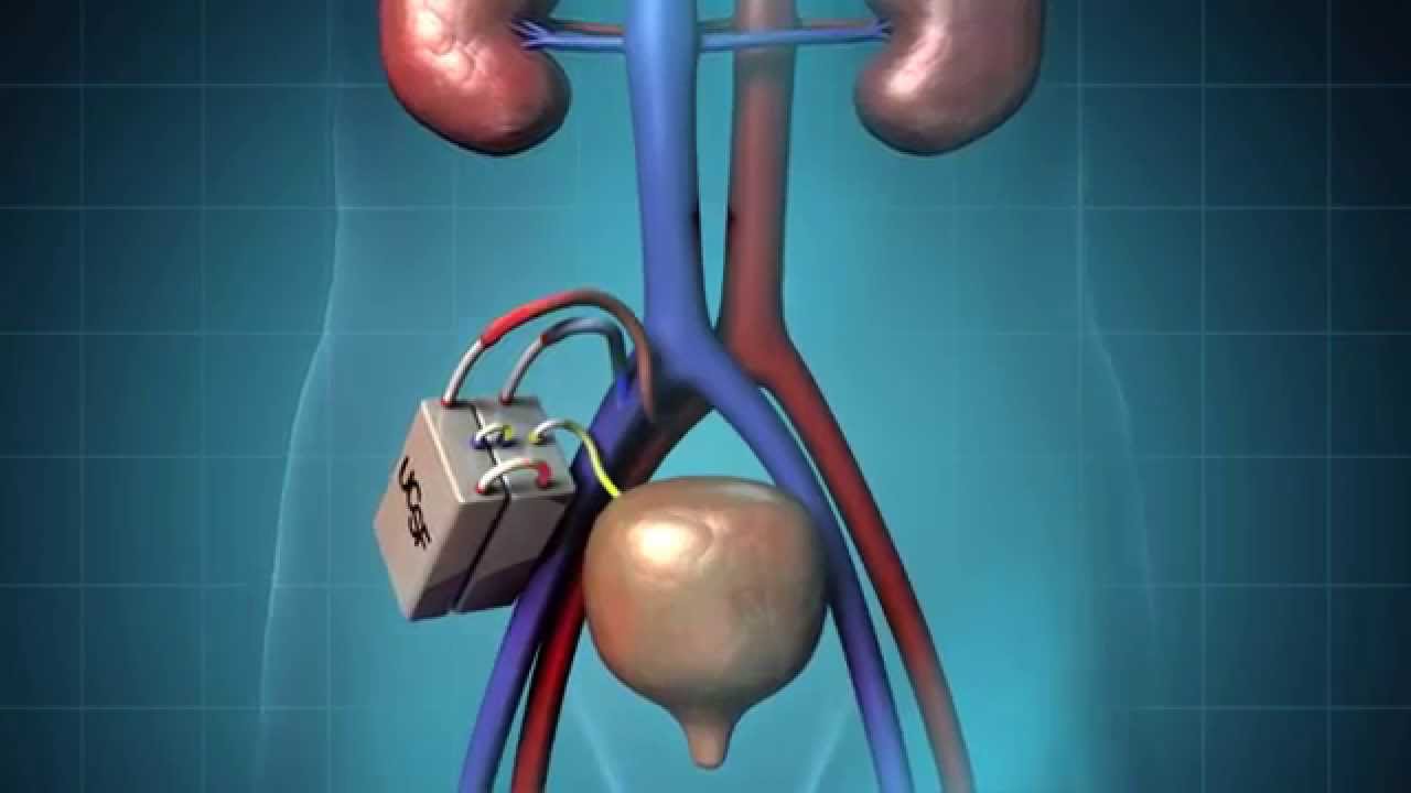 new research on kidney transplant