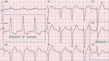 How to identify Left Bundle Branch Block in an ECG?
