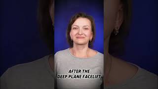 Targeted facial lift. Balanced, natural results. #facelift #beforeandafter