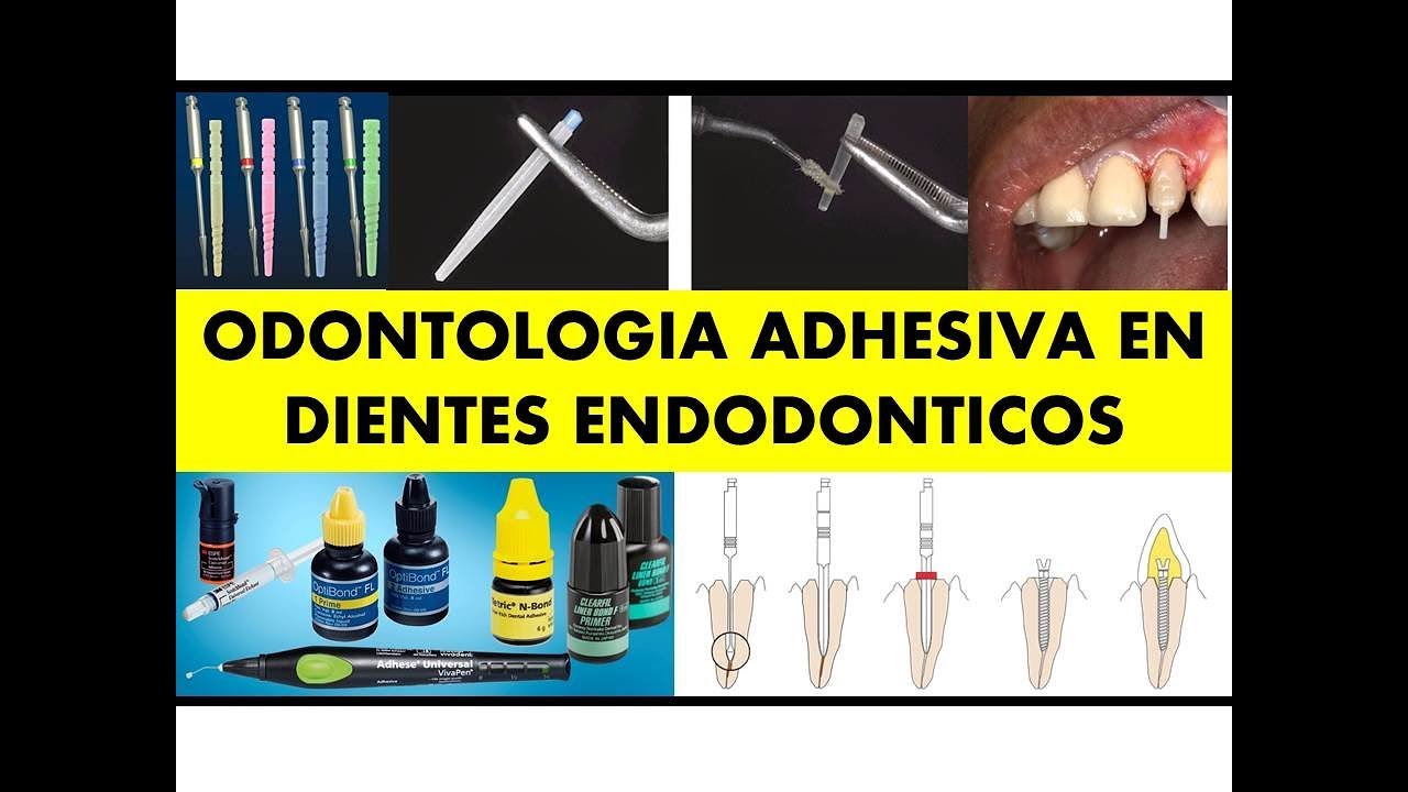 "ODONTOLOGÍA ADHESIVA EN DIENTES TRATADOS ENDODONTICAMENTE" por el Dr