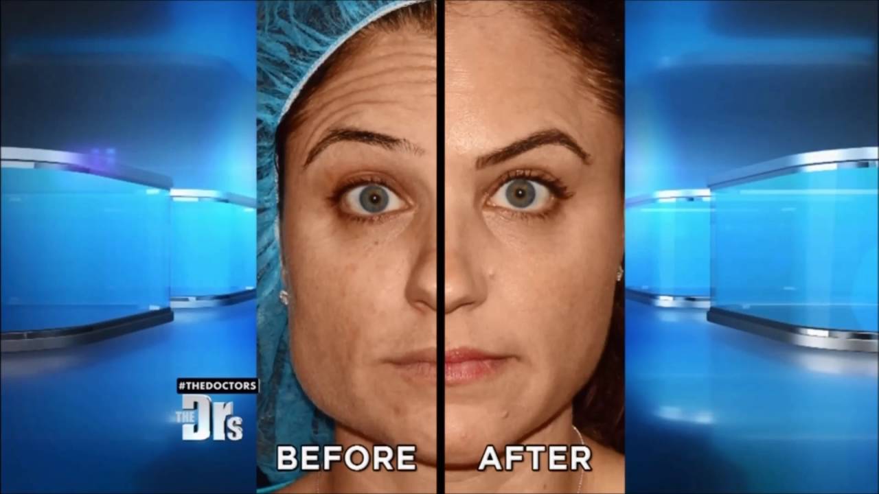 FDA approves Botox injections to erase forehead wrinkles