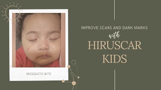 Top 20+ hiruscar kid review hot nhất
