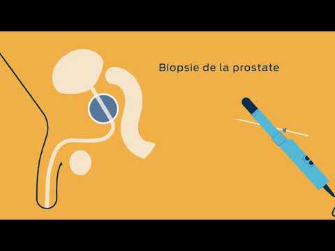 Les examens pour diagnostiquer et surveiller le cancer de la prostate