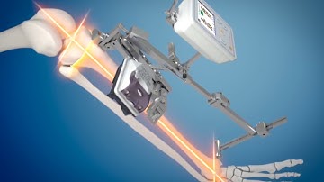 Partial Knee Replacement 3D Surgical Animation - UniAlign