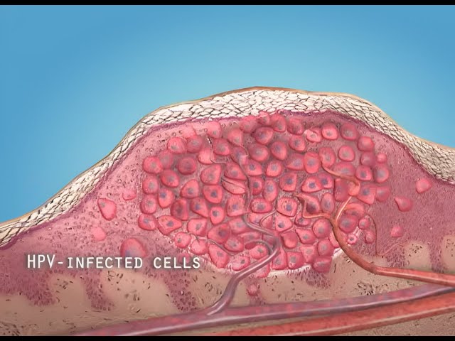 What are warts (HPV)? - 3D animation class=