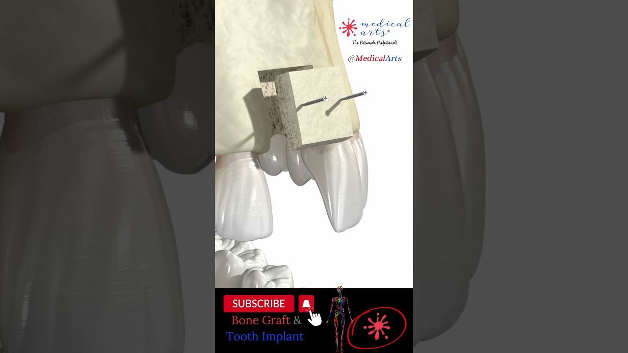 Bone Graft and Tooth Implant