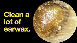 ASMR 고막에 붙은 딱딱한 귀지 제거 (Hard Earwax Removal) #earcleaning #asmr #satisfying #earwax removal