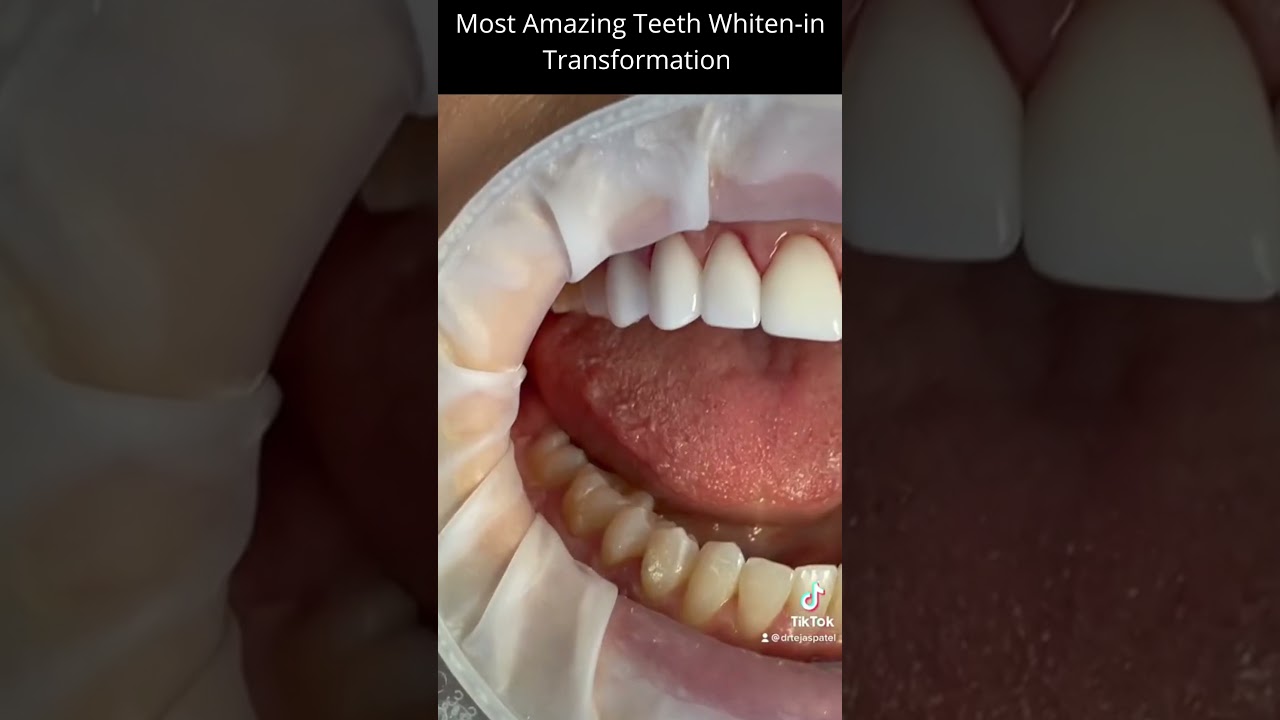 Most Amazing Teeth Whiten-in Transformation/Motivation by drtejaspatel